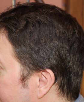 male-pattern-hair-loss-thicker-crown-and-thicker-sideburns.-jpeg-280x340